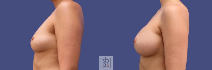 Before & After Breast Augmentation Case 294 View #2 View in Torrance, CA