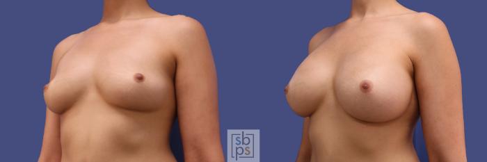 Before & After Breast Augmentation Case 294 View #3 View in Torrance, CA