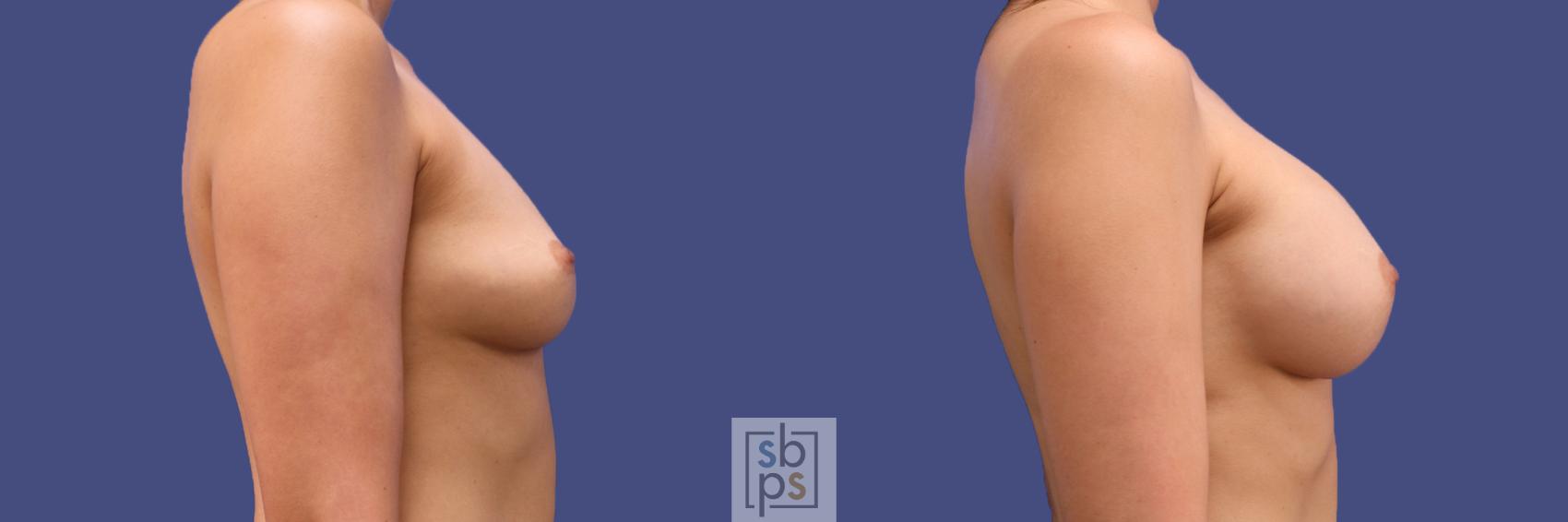 Before & After Breast Augmentation Case 294 View #4 View in Torrance & Los Angeles, CA, CA
