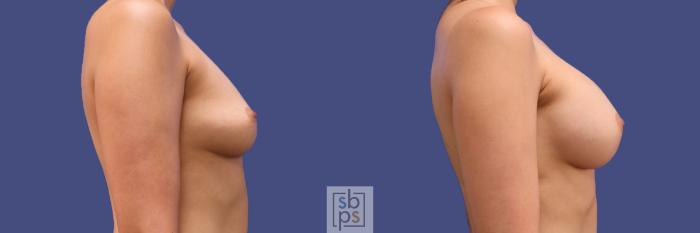 Before & After Breast Augmentation Case 294 View #4 View in Torrance, CA