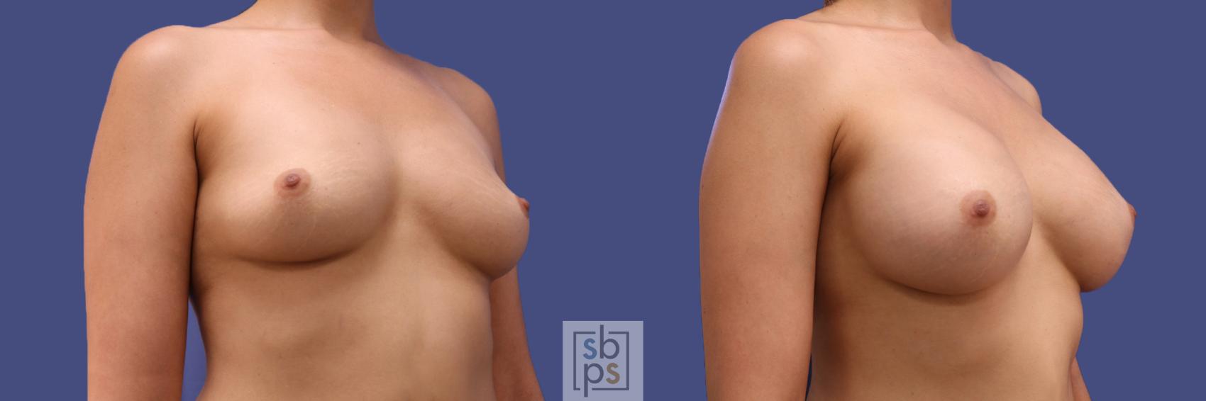 Before & After Breast Augmentation Case 294 View #5 View in Torrance & Los Angeles, CA, CA