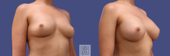 Before & After Breast Augmentation Case 294 View #5 View in Torrance, CA