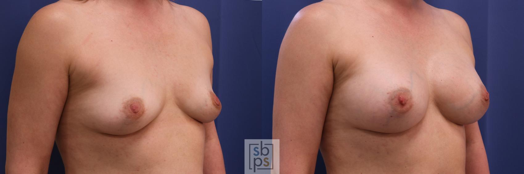 Before & After Breast Augmentation Case 295 View #3 View in Los Angeles, Torrance & Long Beach, CA