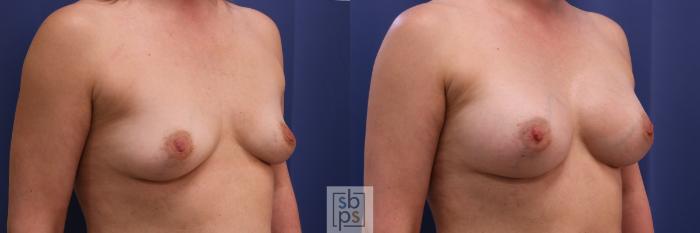 Before & After Breast Augmentation Case 295 View #3 View in Torrance, CA