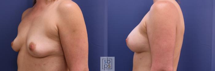 Before & After Breast Augmentation Case 295 View #4 View in Torrance, CA