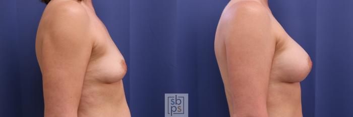 Before & After Breast Augmentation Case 295 View #5 View in Torrance, CA