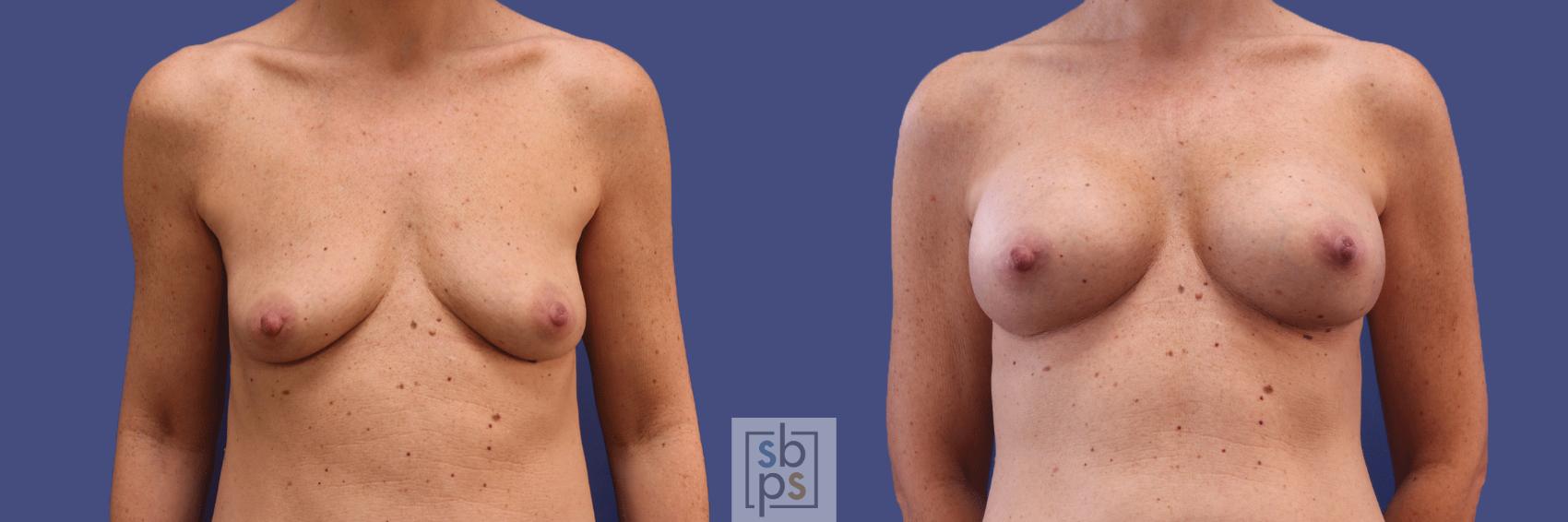 Before & After Breast Augmentation Case 296 View #1 View in Torrance, CA