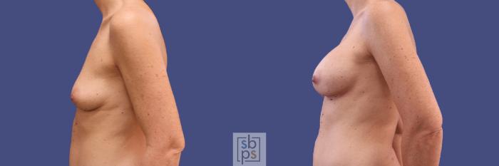 Before & After Breast Augmentation Case 296 View #2 View in Torrance, CA