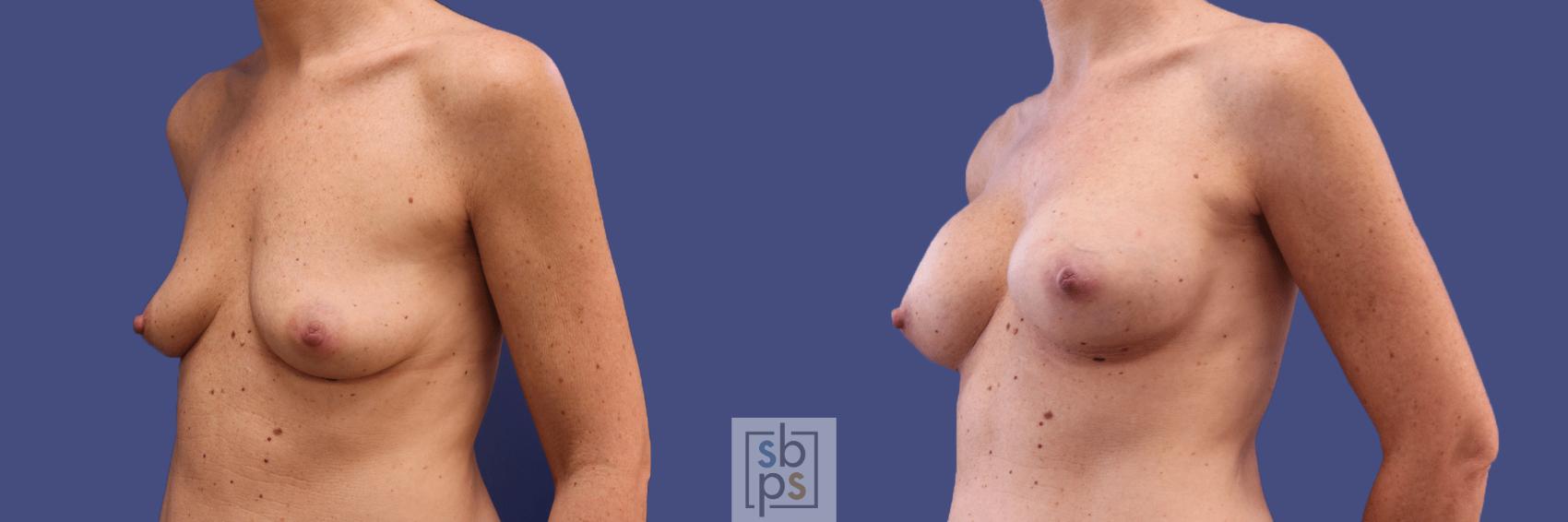 Before & After Breast Augmentation Case 296 View #3 View in Los Angeles & Torrance, CA, CA