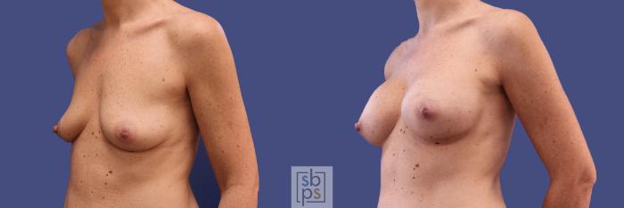 Before & After Breast Augmentation Case 296 View #3 View in Torrance, CA