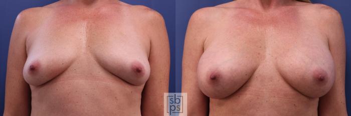 Before & After Breast Augmentation Case 298 View #1 View in Torrance, CA