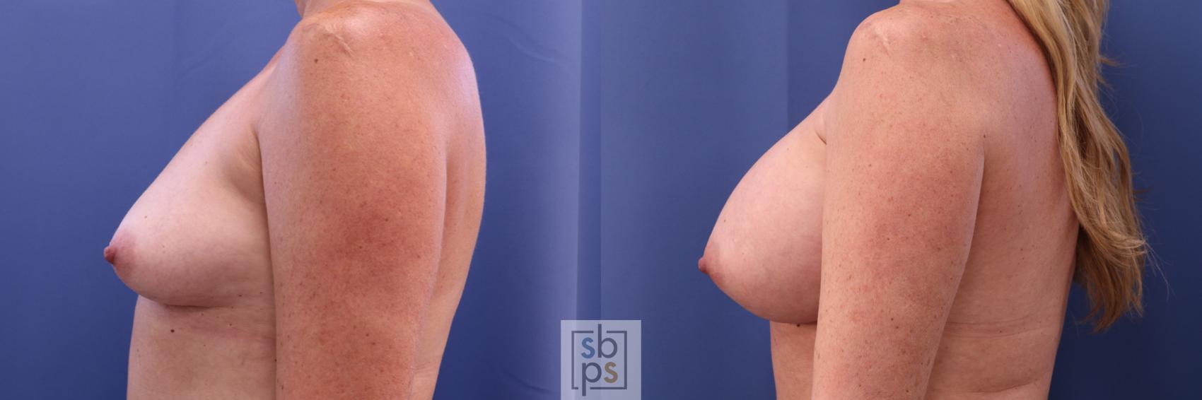 Before & After Breast Augmentation Case 298 View #2 View in Torrance & Los Angeles, CA, CA