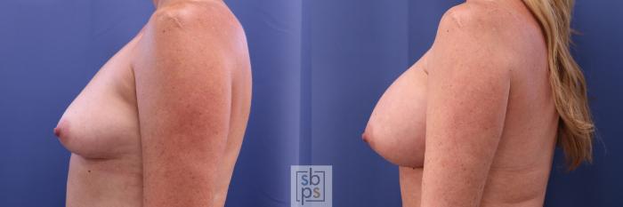 Before & After Breast Augmentation Case 298 View #2 View in Torrance, CA