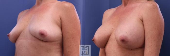 Before & After Breast Augmentation Case 298 View #3 View in Torrance, CA