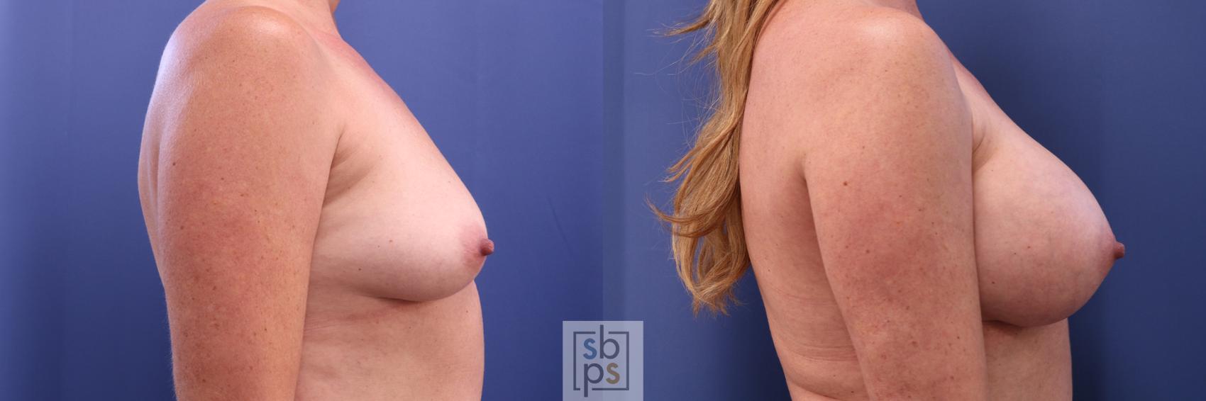 Before & After Breast Augmentation Case 298 View #4 View in Torrance & Los Angeles, CA, CA