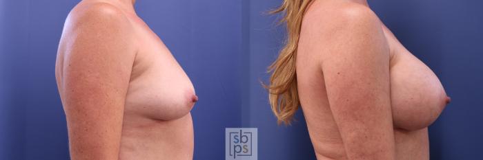 Before & After Breast Augmentation Case 298 View #4 View in Torrance, CA