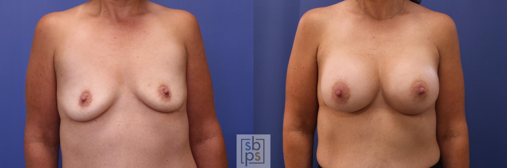 Before & After Breast Augmentation Case 302 View #1 View in Torrance, CA