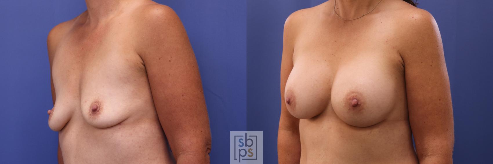 Before & After Breast Augmentation Case 302 View #3 View in Los Angeles & Torrance, CA, CA