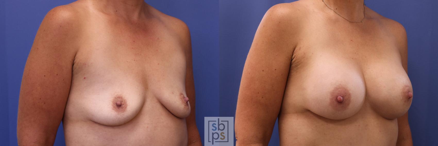 Before & After Breast Augmentation Case 302 View #5 View in Torrance & Los Angeles, CA, CA