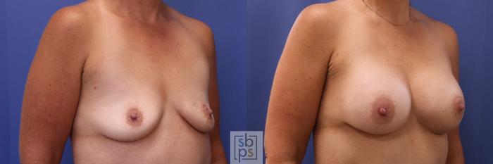 Before & After Breast Augmentation Case 302 View #5 View in Torrance, CA