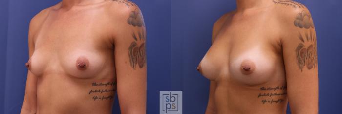 Before & After Breast Augmentation Case 303 View #2 View in Torrance, CA