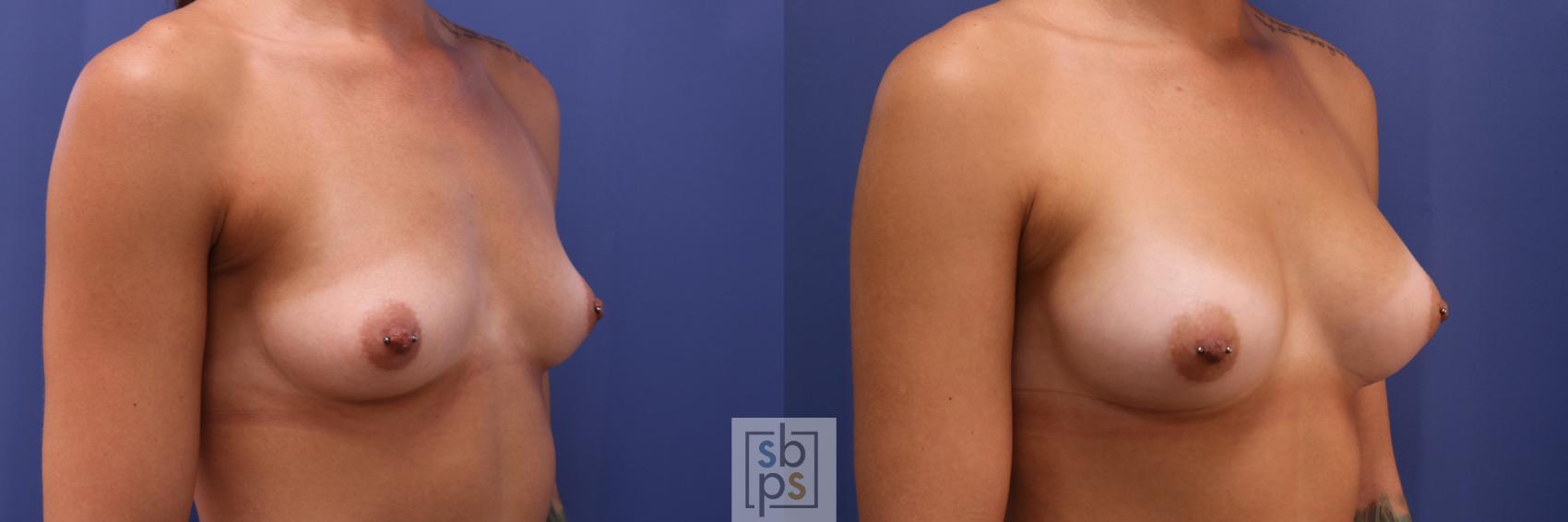 Before & After Breast Augmentation Case 303 View #3 View in Torrance & Los Angeles, CA, CA