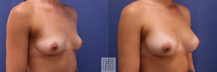 Before & After Breast Augmentation Case 303 View #3 View in Torrance, CA