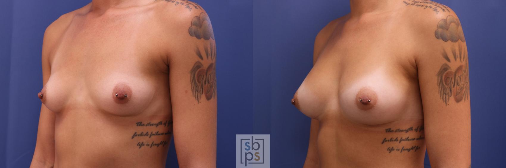 Before & After Breast Augmentation Case 303 View #5 View in Torrance & Los Angeles, CA, CA