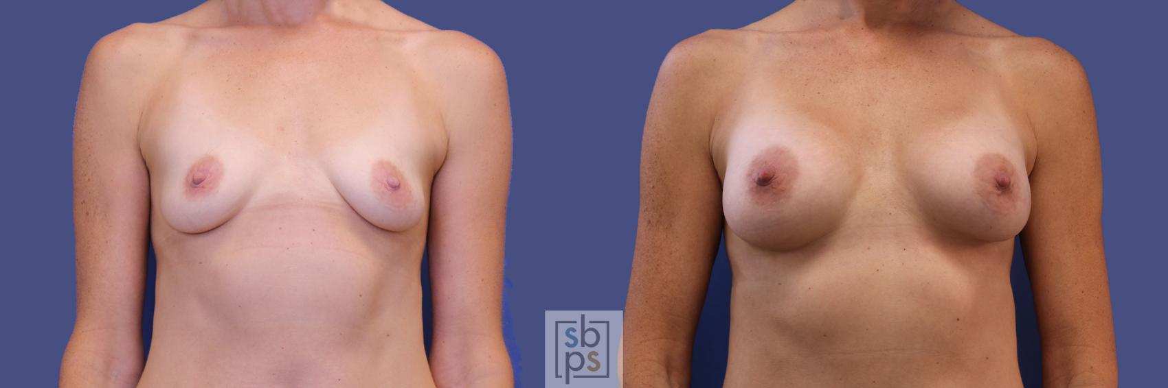 Before & After Breast Augmentation Case 309 View #1 View in Torrance, CA