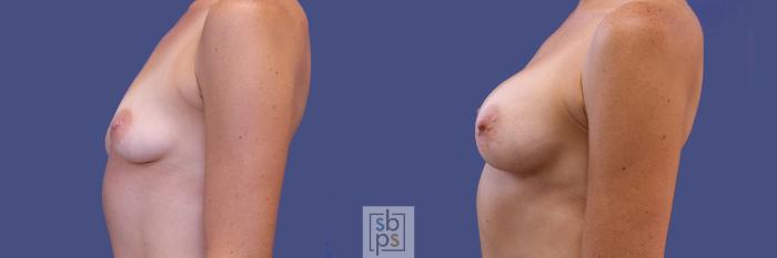 Before & After Breast Augmentation Case 309 View #2 View in Torrance, CA