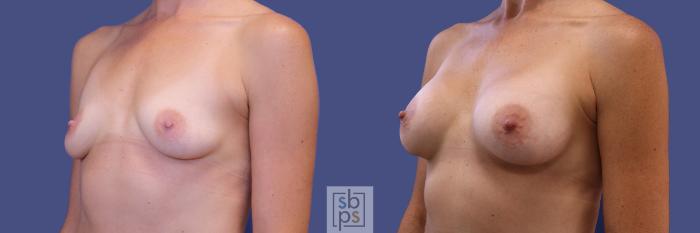 Before & After Breast Augmentation Case 309 View #3 View in Torrance, CA
