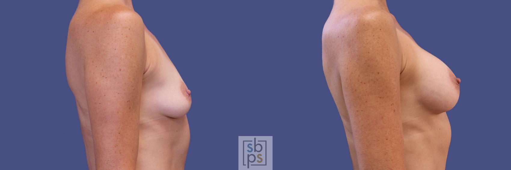 Before & After Breast Augmentation Case 309 View #4 View in Torrance & Los Angeles, CA, CA