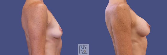 Before & After Breast Augmentation Case 309 View #4 View in Torrance, CA