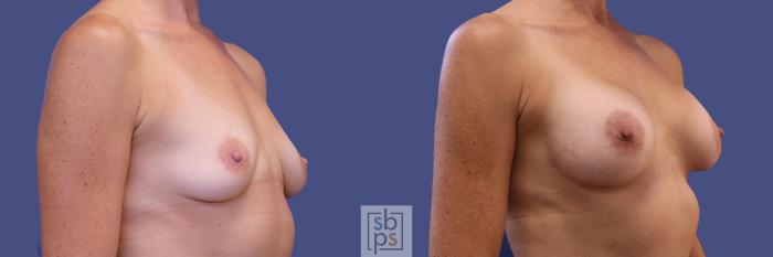 Before & After Breast Augmentation Case 309 View #5 View in Torrance, CA