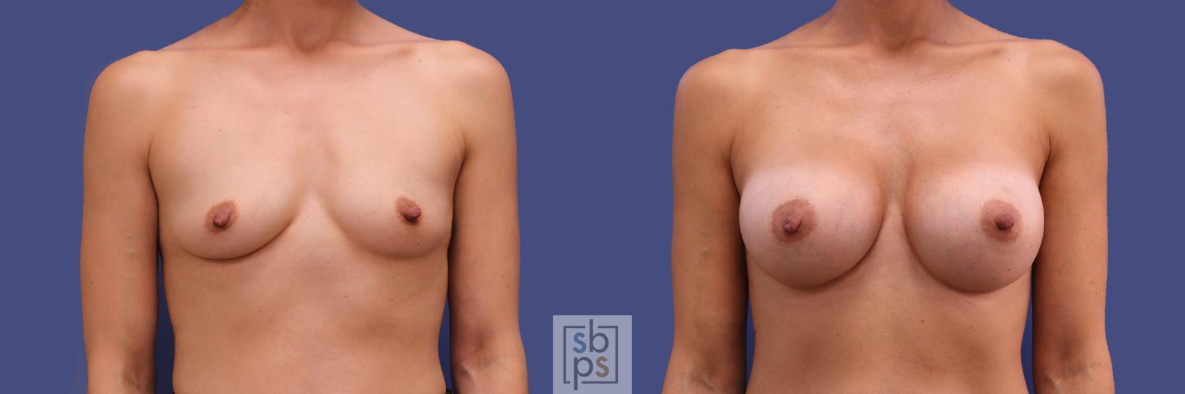 Before & After Breast Augmentation Case 312 View #1 View in Torrance, CA