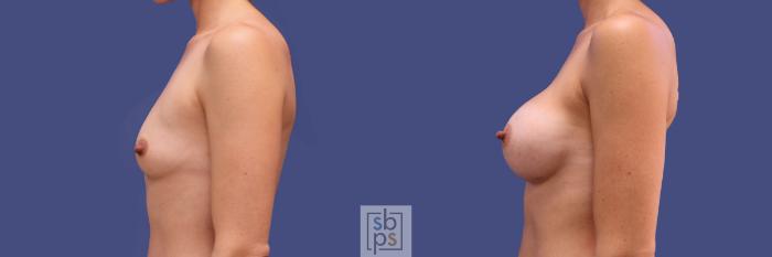 Before & After Breast Augmentation Case 312 View #2 View in Torrance, CA