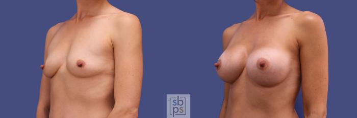 Before & After Breast Augmentation Case 312 View #3 View in Torrance, CA