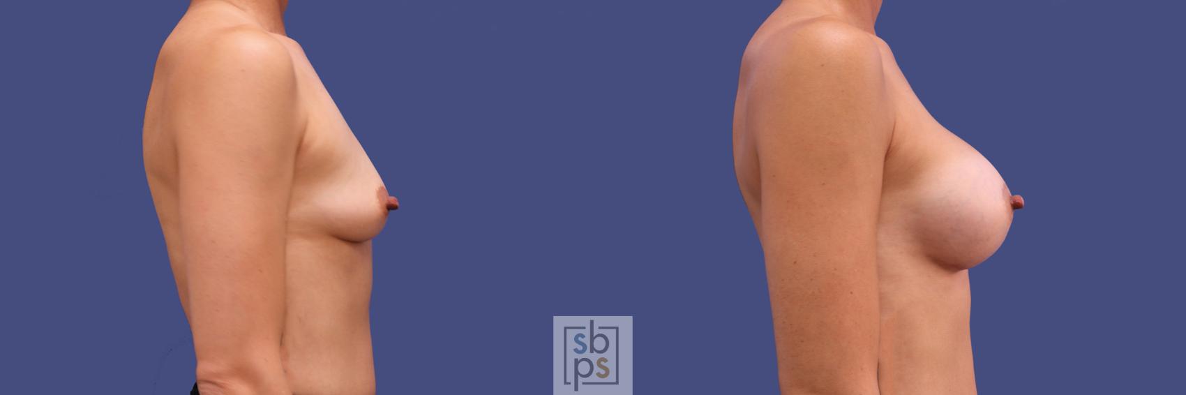 Before & After Breast Augmentation Case 312 View #4 View in Torrance & Los Angeles, CA, CA