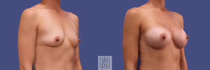 Before & After Breast Augmentation Case 312 View #5 View in Torrance, CA