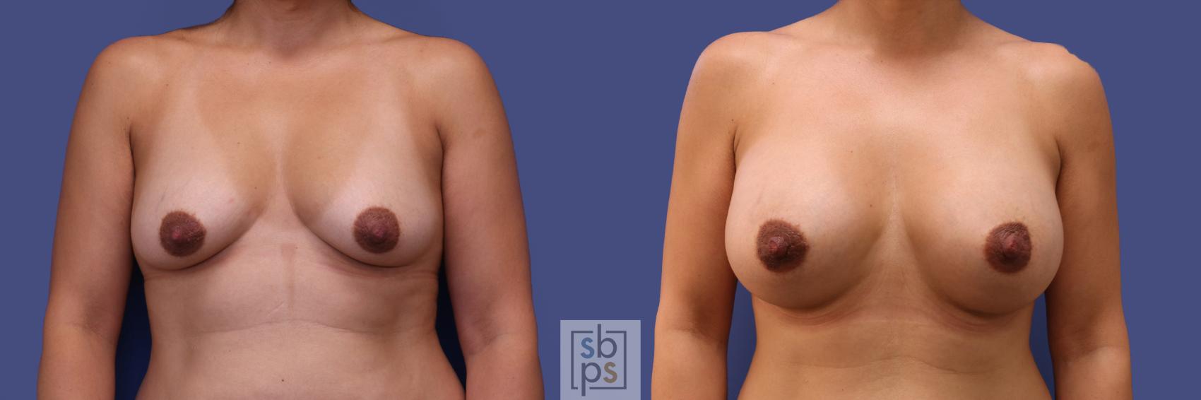 Before & After Breast Augmentation Case 313 View #1 View in Torrance, CA
