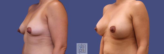 Before & After Breast Augmentation Case 313 View #3 View in Torrance, CA
