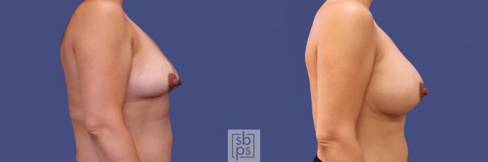 Before & After Breast Augmentation Case 313 View #4 View in Torrance, CA