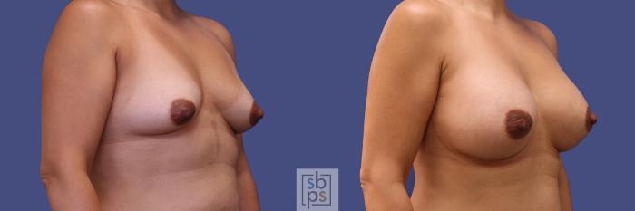 Before & After Breast Augmentation Case 313 View #5 View in Torrance, CA