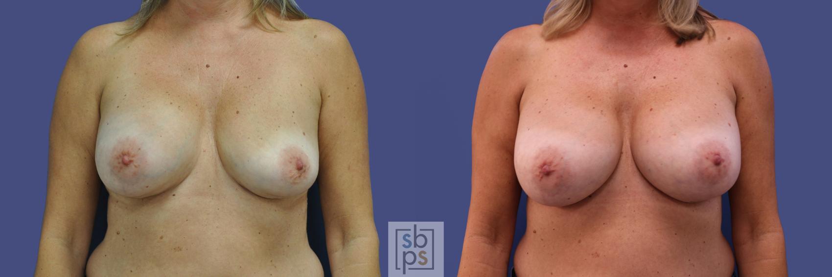 Before & After Breast Augmentation Case 315 View #1 View in Torrance, CA