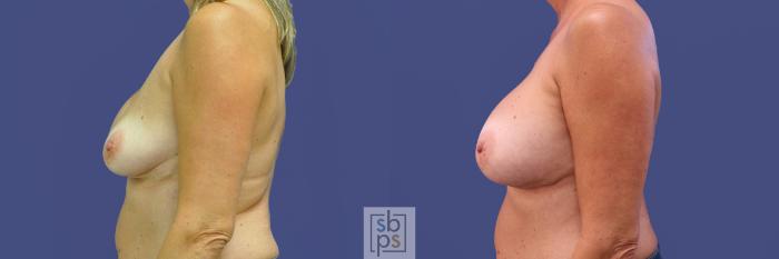 Before & After Breast Augmentation Case 315 View #2 View in Torrance, CA