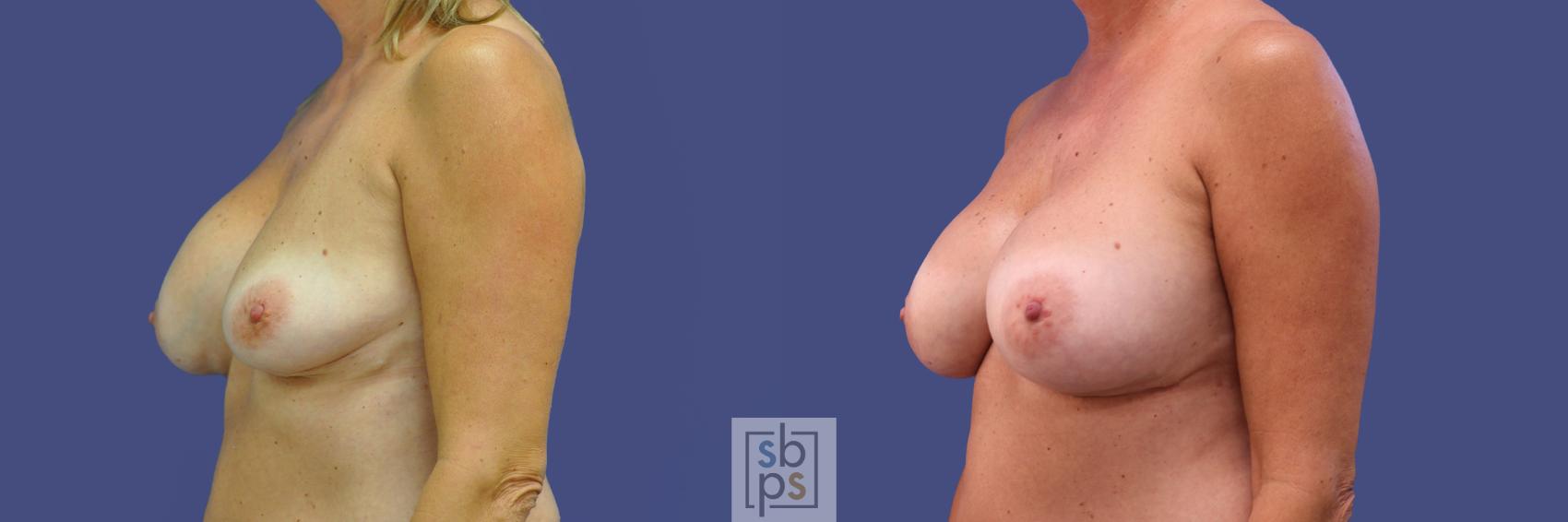 Before & After Breast Augmentation Case 315 View #3 View in Torrance & Los Angeles, CA, CA