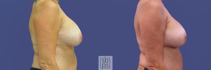 Before & After Breast Augmentation Case 315 View #4 View in Torrance, CA