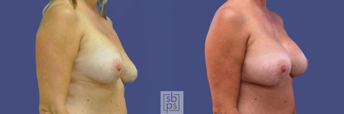 Before & After Breast Augmentation Case 315 View #5 View in Torrance, CA