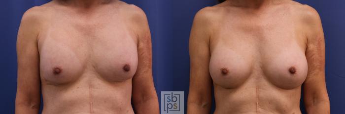 Before & After Breast Augmentation Case 325 View #1 View in Torrance, CA