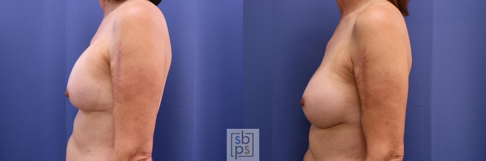 Before & After Breast Augmentation Case 325 View #2 View in Torrance & Los Angeles, CA, CA